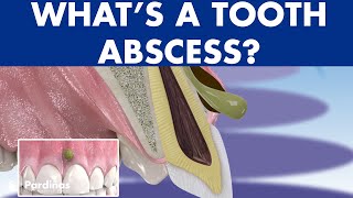 TOOTH ABSCESS dental infection  PHLEGMON symptoms and treatment © [upl. by Atalanti]