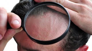 Plaque psoriasis on face pictures pics images mild symptoms skin rash [upl. by Lerred15]