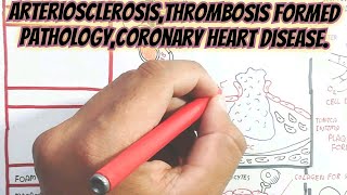 ArteriosclerosisThrombosis Formed PathologyCoronary Heart Disease umerfarooqbiology7083 [upl. by Duwe]