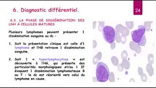 Hemato 13Leucémie lymphoide chronique LLC Dr Abbadi [upl. by Sarena]