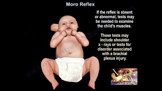 physical exam Newborn Normal Primitive Reflexes  Moro [upl. by Grose]