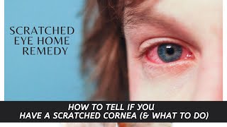 Scratched eye home remedy  HOW TO TELL IF YOU HAVE A SCRATCHED CORNEA amp WHAT TO DO [upl. by Freida679]