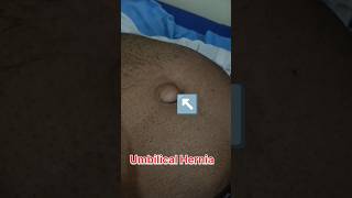 Umbilical Hernia Umbilical hernia showing video  pregnant ultrasound medical baby shorts usg [upl. by Grussing]