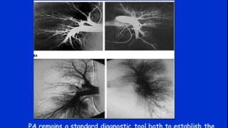 Chronic Thromboembolic Pulmonary Hypertension  Medical Therapy [upl. by Marge]