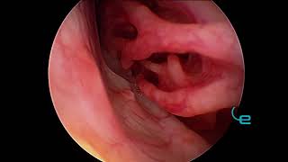 Rhinoscopy leishmanosis in Border Collie Nasal Granulomatosis [upl. by Cecilla]