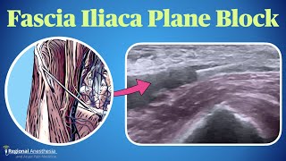 Fascia Iliaca Plane Block [upl. by Adnirak]