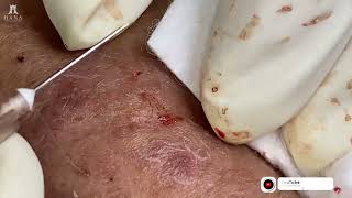 Big Cystic Acne Blackheads Extraction Blackheads amp Milia Whiteheads Removal Pimple Popping 2024 [upl. by Florida791]