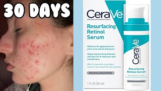 I TRIED THE CERAVE RESURFACING RETINOL SERUM FOR MY ACNE  1 Month Test [upl. by Pliam122]