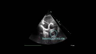 〖Echocardiography〗 Acute pulmonary embolism with a thrombus in the right pulmonary artery 🏥 [upl. by Leonhard]