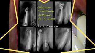 Surgical Endodontics  Apicoectomy or rootend resection [upl. by Purity531]