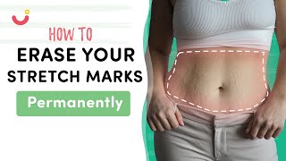 How to Get Rid of Stretch Marks Permanently  Natural Ways to Fade Stretch Marks with Home Remedies [upl. by Ardeed]