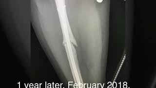 Femur fracture xray update [upl. by Gyasi952]