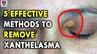 5 Effective Methods to Remove Xanthelasma  Best Health Tips for CHRONIC DISEASES [upl. by Alan940]