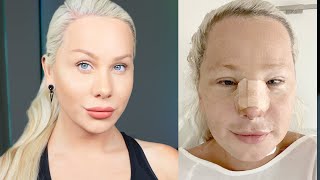 I had Facial Feminisation Surgery One year update [upl. by Lexerd106]