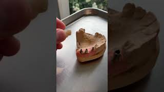 Splinted Zirconia Implant Crowns [upl. by Stillmann913]