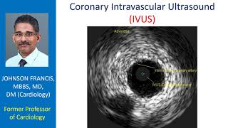 Coronary Intravascular Ultrasound IVUS [upl. by Nomra]