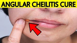 How to Get Rid of Angular Cheilitis at Home Naturally amp FAST [upl. by Kowalski275]