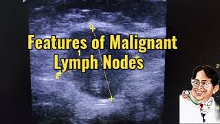 How to identify Malignant Lymph Nodes कैंसर कैसे पहचाने [upl. by Nomzed]