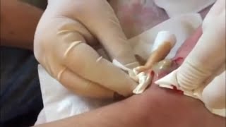 Popping huge blackheads and Giant Pimples  Best Pimple Popping Videos 157 [upl. by Uamak]