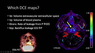 2022  Perfusion in the Head and Neck CT and MR  Remy Lobo [upl. by Nagud]