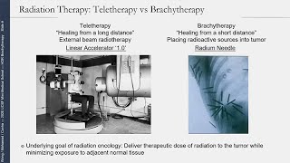 No Beam Required InsideOut Radiotherapy HDR Brachytherapy for Prostate Cancer [upl. by Nelleeus736]