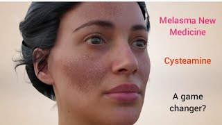 Melasma New Medicine  Cysteamine  Is it a game changer melasma melasmacream melasmatreatment [upl. by Kariotta]