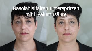 Nasolabialfalten unterspritzen mit Hyaluronsäure [upl. by Pantheas476]