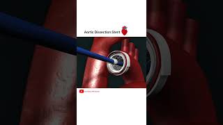 Aortic dissection Stent grafting cardiology shorts [upl. by Norrat]