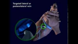 An Animated Demonstration of Placement of an LV lead in a Coronary Vein [upl. by Tades]