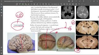 5 Lissencephaly [upl. by Nosnevets]