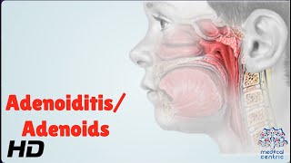 AdenoiditisAdenoids Everything You Need To Know [upl. by Egroeg799]