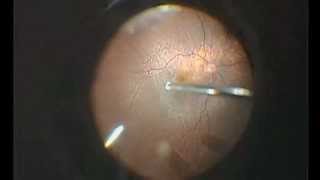 Vitrectomy for dropped lens fragments [upl. by Eemia]