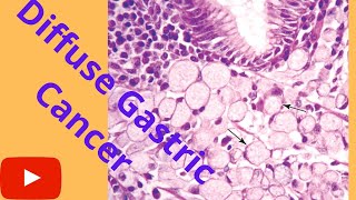 Diffuse Gastric CancerSignet ring cell Cancer Microscopy HistopathologyShorts [upl. by Osanna]