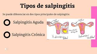 Salpingitis Crónica [upl. by Northington]