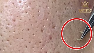 กดสิว blackheads filaments on nose remove with tweezers [upl. by Silevi]