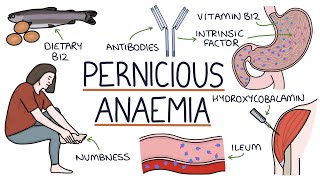 Understanding Pernicious Anaemia B12 Deficiency [upl. by Alitta]