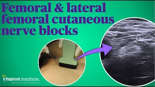 Femoral and lateral femoral cutaneous nerve blocks [upl. by Esenwahs29]