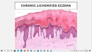 Lecture78 Eczematous disorders PartI Rooks chapter 39 [upl. by Wenn146]