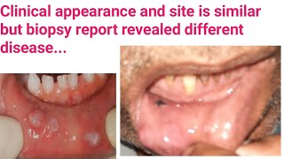 MucoceleWhat is Mucocele amp its treatmentBiopsy is mandatory after surgical removal of Lesion why [upl. by Ahsiea285]