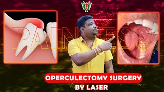 Operculectomy With diode Laser  DR SANJEEB ROUT drsanjeebrout youtube yt surgicalskills [upl. by Pettifer]