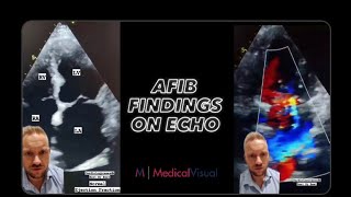 Echocardiography Findings in Atrial Fibrillation Afib [upl. by Kleper]