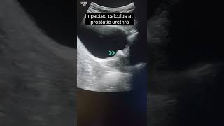 calculus prostatic urethra  Vasical calculus ultrasound [upl. by Nnaitak]