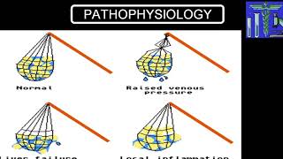 PULMONARY EDEMA [upl. by Gaye]