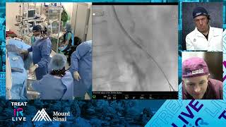 Transradial Stenting of Mesenteric Artery Occlusion for Chronic Mesenteric Ischemia [upl. by Ataynik]