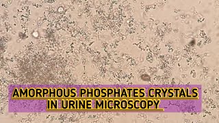 Amorphous Phosphates crystals seen in urine microscopyAlkaline crystalsRoutine urine examination [upl. by Othilia]