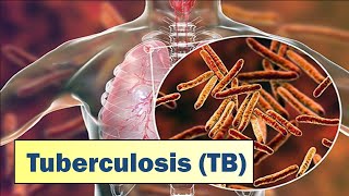 Tuberculosis TB I Causes Symptoms Prevention amp Treatment [upl. by Uhayile818]