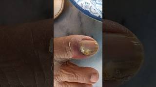 How to treat fungal nails infections skincare viralvideo [upl. by Zelle]