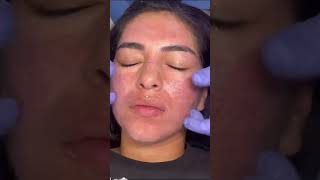 Rosas Acne Scar Journey Continues with Sublative Laser [upl. by Akilat]