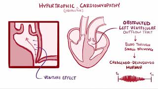 Hypertrophic cardiomyopathy HCM causes symptoms treatment amp pathology [upl. by Nataline]