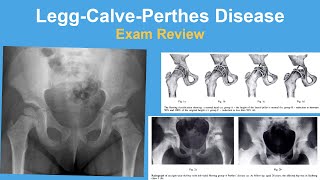 LeggCalvePerthes Disease Coxa Plana Exam Review  Rachel Goldstein MD [upl. by O'Malley168]